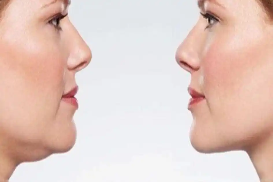 Tập gym có giảm mỡ mặt không